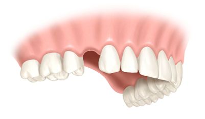 einzelzahn implantat