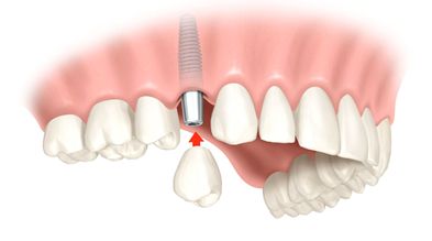 einzelzahn implantat