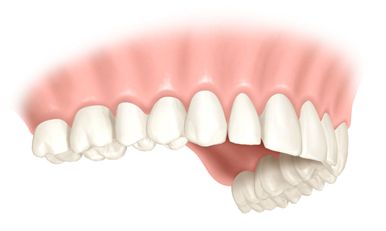 einzelzahn implantat