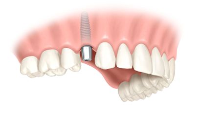 einzelzahn implantat